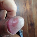 Genital_psoriasis_penis_ICD_10_L40.1_First_Derm