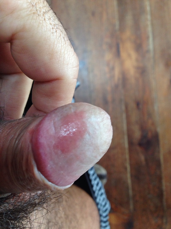 Genital_psoriasis_penis_ICD_10_L40.1_First_Derm