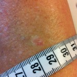 Skin cancer Squamous cell carcinoma